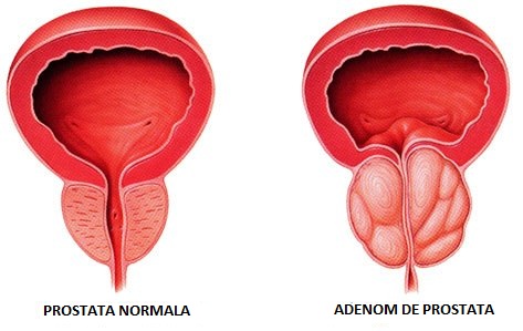 prostata adenomatosa significado