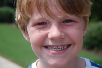 Cand copilul tau are nevoie de aparat dentar