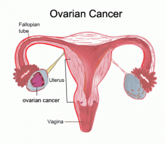 Totul despre cancerul ovarian. Simptome, tratament, factori de risc si de prevenire