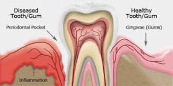Tratamente naturale pentru parodontoza